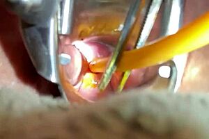ABD and CBT made up Medical play where there was insertion of a cervical object
