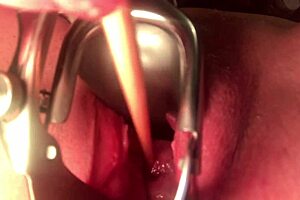 cervix stretching and sounding in extreme detail