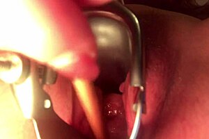 cervix stretching and sounding in extreme detail